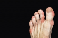 Women Affected by Gout Has Doubled