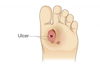 Dealing With Diabetic Foot Ulcers