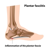 Risk Factors and Symptoms of Plantar Fasciitis